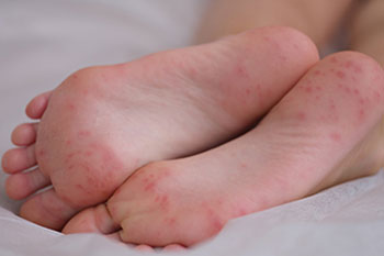 foot infections